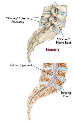 Stenotic