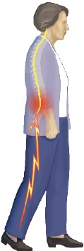 Lumbar Spinal Stenosis