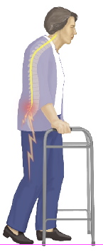 Diagnosing Lumbar Spinal Stenosis